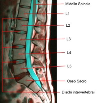 MRI lombare